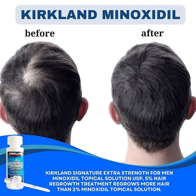 kirkland-minoxidil-5-topical-solution-